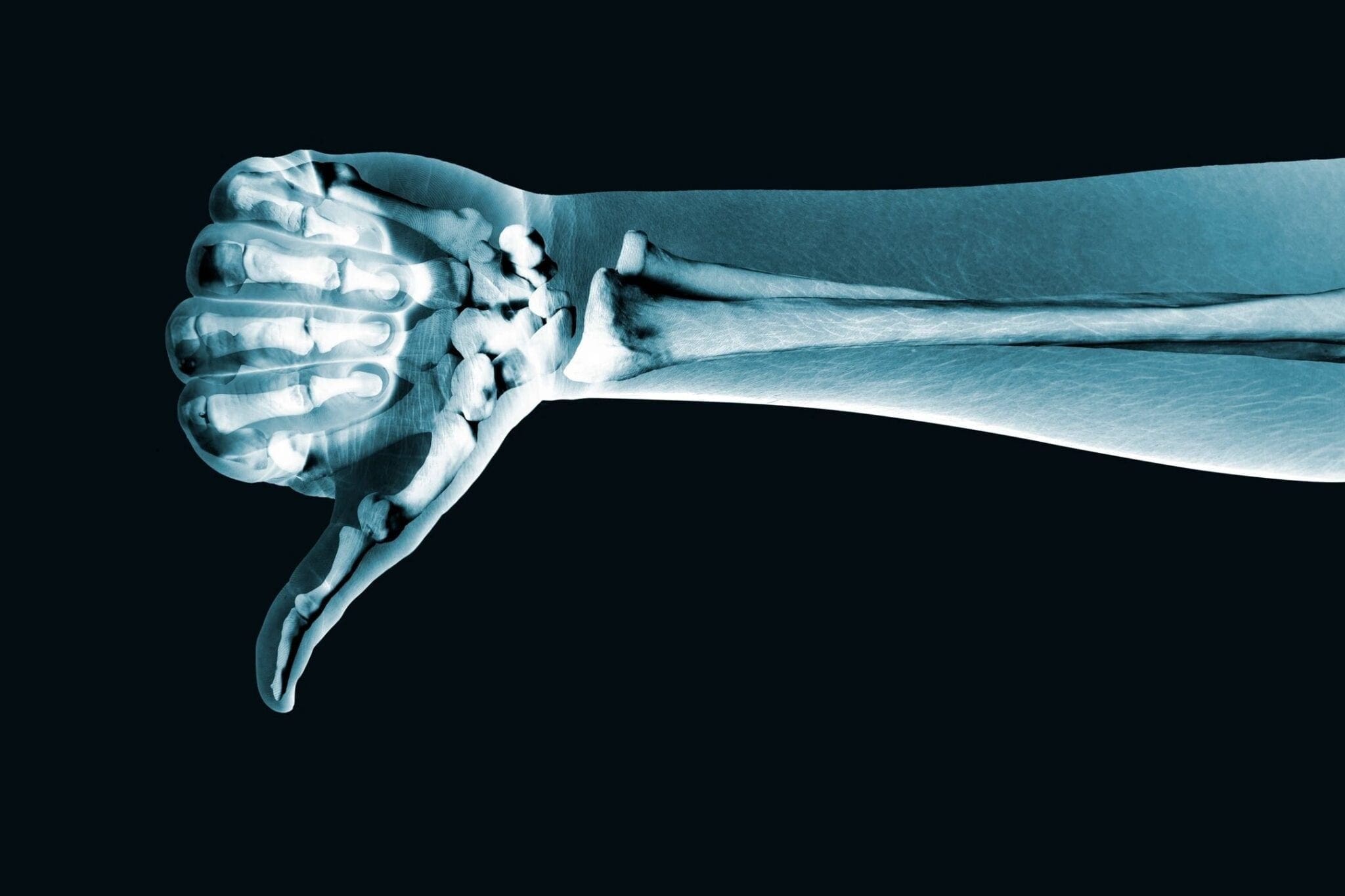 X-Ray Thumbs-down